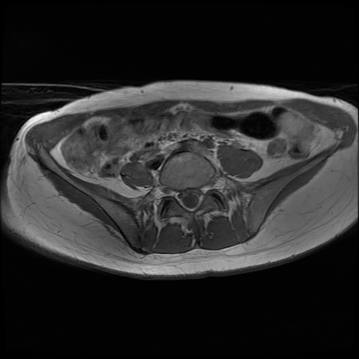 File:Normal female pelvis MRI (retroverted uterus) (Radiopaedia 61832-69933 Axial T1 4).jpg