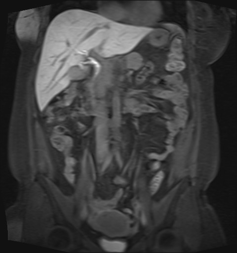 File:Normal hepatobiliary phase liver MRI (Radiopaedia 58968-66230 B 30).jpg