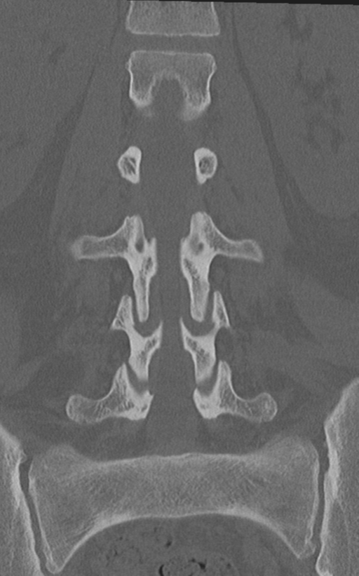 Normal lumbar spine CT (Radiopaedia 46533-50986 Coronal bone window 42).png