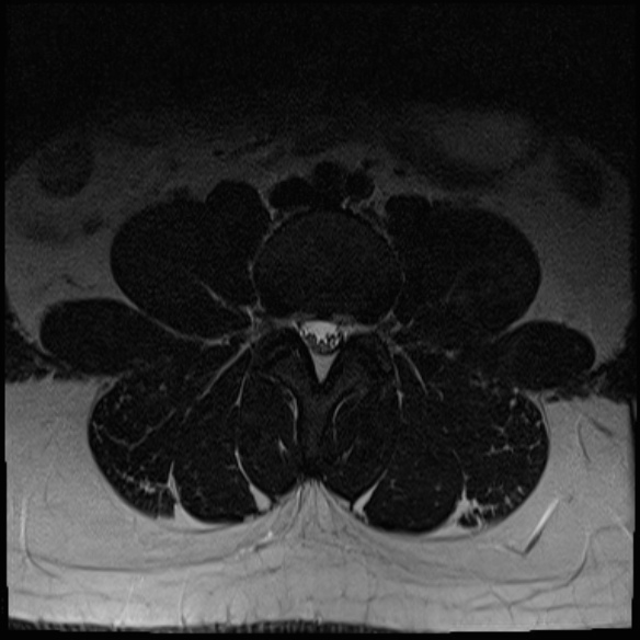File:Normal lumbar spine MRI (Radiopaedia 47857-52609 Axial T2 9).jpg