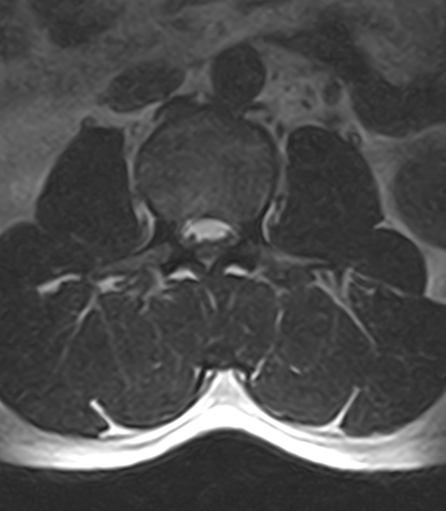 Normal lumbar spine MRI - low-field MRI scanner (Radiopaedia 40976-43699 Axial T2 40).jpg