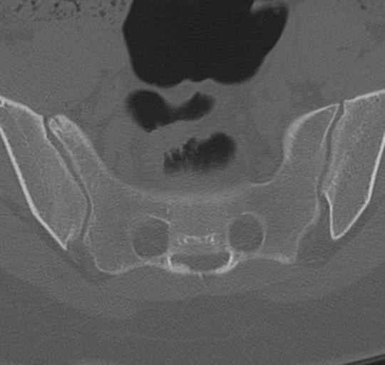 File:Normal lumbosacral CT (Radiopaedia 37923-39867 Axial bone window 91).png