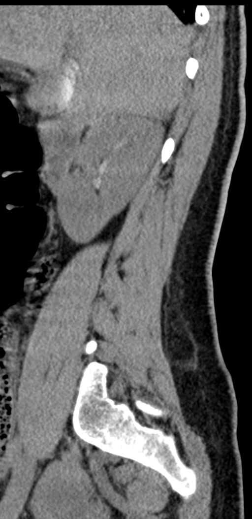 Normal lumbosacral CT (Radiopaedia 37923-39867 E 87).png