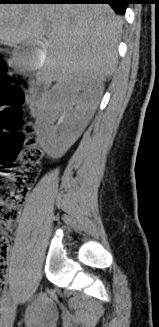 Normal lumbosacral CT (Radiopaedia 37923-39867 E 91).png