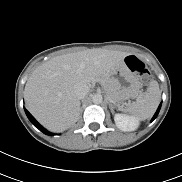 File:Normal multiphase CT liver (Radiopaedia 38026-39996 Axial C+ delayed 18).jpg
