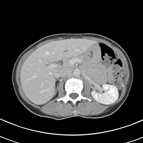 File:Normal multiphase CT liver (Radiopaedia 38026-39996 C 28).jpg