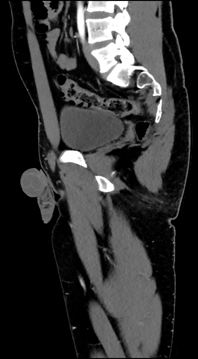 Normal pelvis CT angiogram (Radiopaedia 84966-100481 C 63).jpg