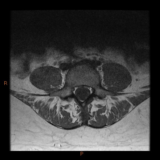 File:Normal spine MRI (Radiopaedia 77323-89408 Axial T1 18).jpg