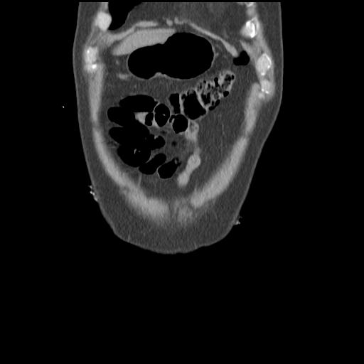 Obstructing renal calculus (Radiopaedia 29517-30016 Coronal non-contrast 7).jpg