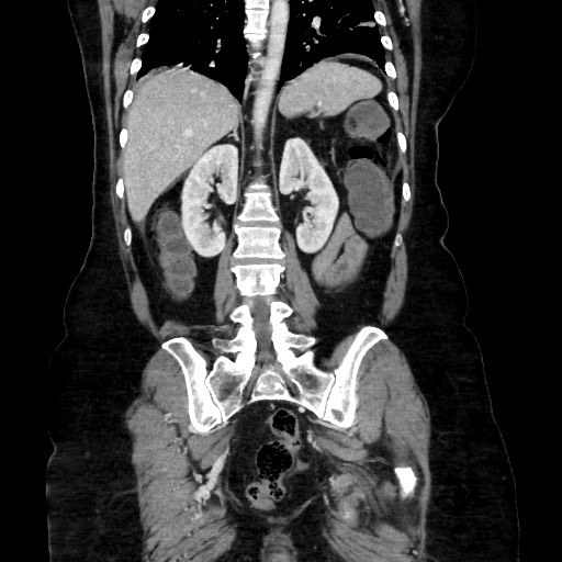 Obstructive distal colonic adenocarcinoma causing cecal perforation (Radiopaedia 86830-102989 C 122).jpg