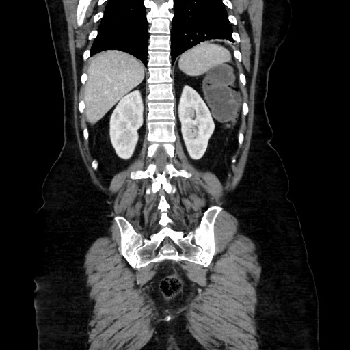 Obstructive distal colonic adenocarcinoma causing cecal perforation (Radiopaedia 86830-102989 C 132).jpg