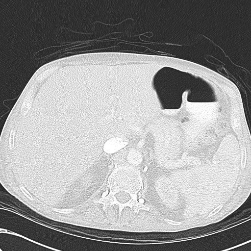 File:Obstructive superior vena cava tumor thrombus (Radiopaedia 28046-28306 Axial lung window 56).jpg