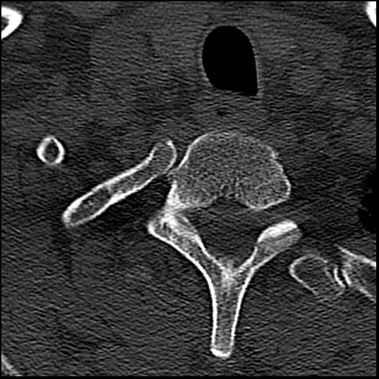 Occipital condyle fracture (type 1) (Radiopaedia 87670-104084 Axial bone window 87).jpg
