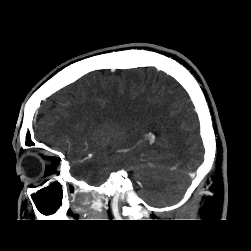 Occipital extradural hematoma simulating venous sinus thrombosis (Radiopaedia 46514-50964 D 25).jpg