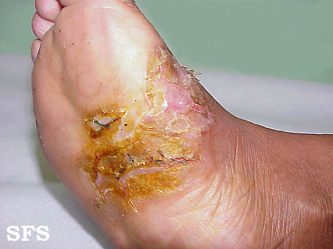 File:Psoriasis (Dermatology Atlas 20).jpg