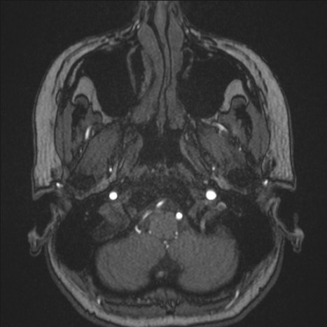 A1 segment hypoplasia (Radiopaedia 83365-97781 Axial TOF MRA 1).jpg
