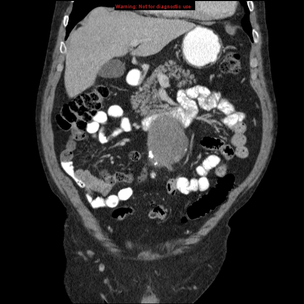 File:Abdominal aortic aneurysm (Radiopaedia 10122-10660 Coronal C+ portal venous phase 7).jpg