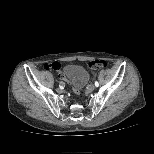 File:Abdominal aortic aneurysm (Radiopaedia 13341-13340 Axial C+ arterial phase 206).jpg