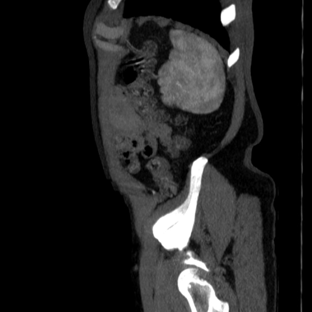 Abdominal aortic aneurysm (Radiopaedia 29248-29660 Sagittal C+ arterial phase 50).jpg