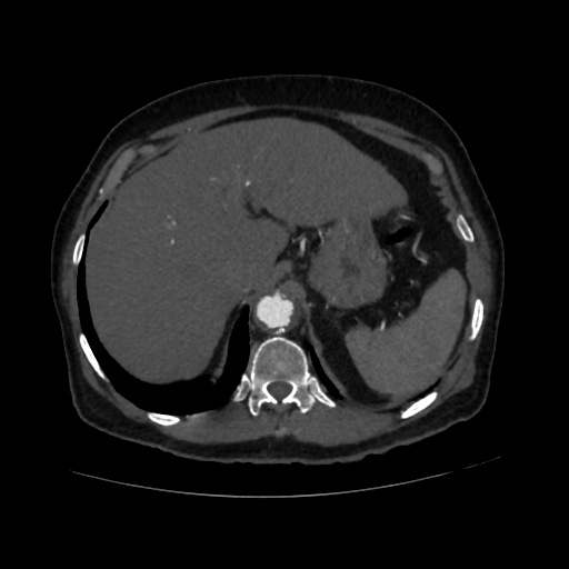 File:Abdominal aortic aneurysm (Radiopaedia 57318-64259 Axial C+ arterial phase 14).jpg