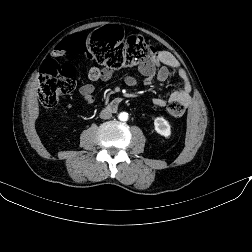 Abdominal aortic aneurysm (Radiopaedia 67117-76452 Axial C+ arterial phase 72).jpg