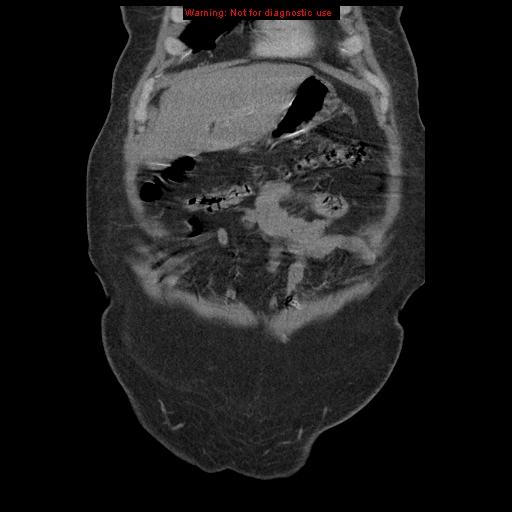 Abdominal aortic aneurysm (Radiopaedia 8190-9038 Coronal C+ arterial phase 21).jpg