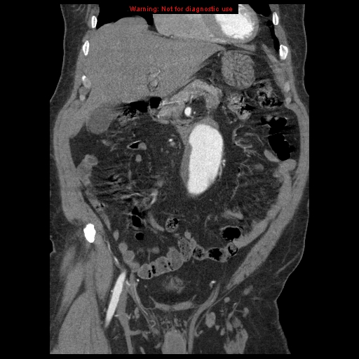 Abdominal aortic aneurysm (Radiopaedia 8190-9038 Coronal C+ arterial phase 41).jpg