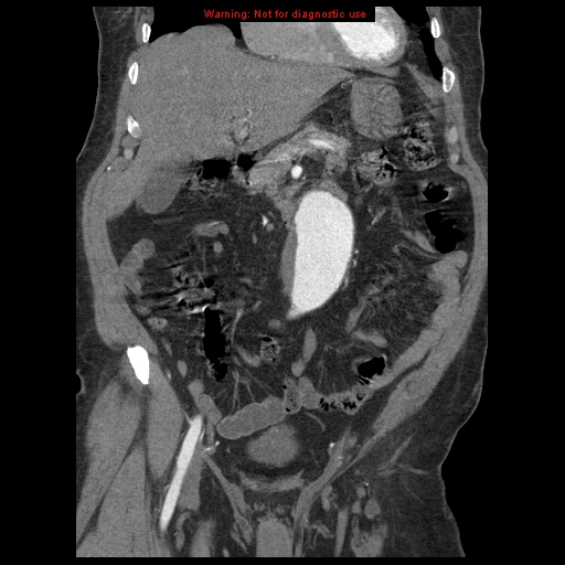 Abdominal aortic aneurysm (Radiopaedia 8190-9038 Coronal C+ arterial phase 43).jpg