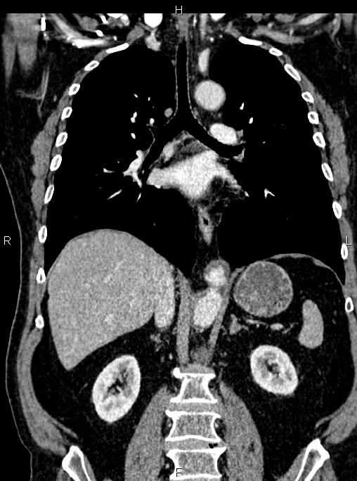Abdominal aortic aneurysm (Radiopaedia 83094-97462 Coronal renal cortical phase 55).jpg
