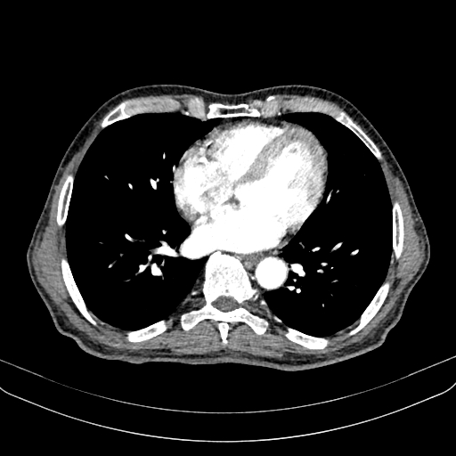 Abdominal aortic aneurysm (Radiopaedia 83581-98689 Axial C+ arterial phase 3).jpg