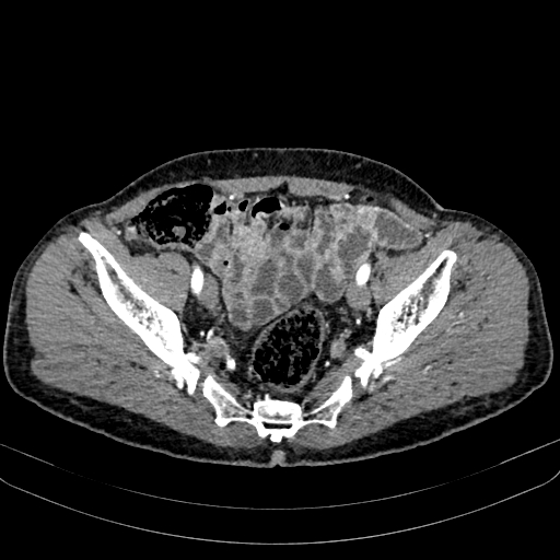 Abdominal aortic aneurysm (Radiopaedia 83581-98689 Axial C+ arterial phase 97).jpg