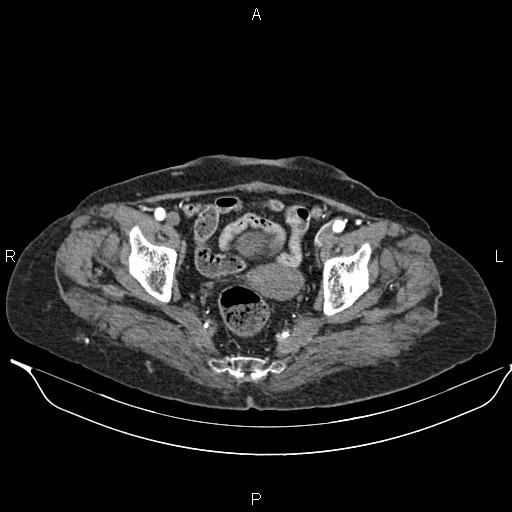 File:Abdominal aortic aneurysm (Radiopaedia 85063-100606 Axial C+ arterial phase 60).jpg