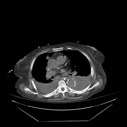 Abdominal aortic aneurysm - impending rupture (Radiopaedia 19233-19247 Axial non-contrast 1).jpg
