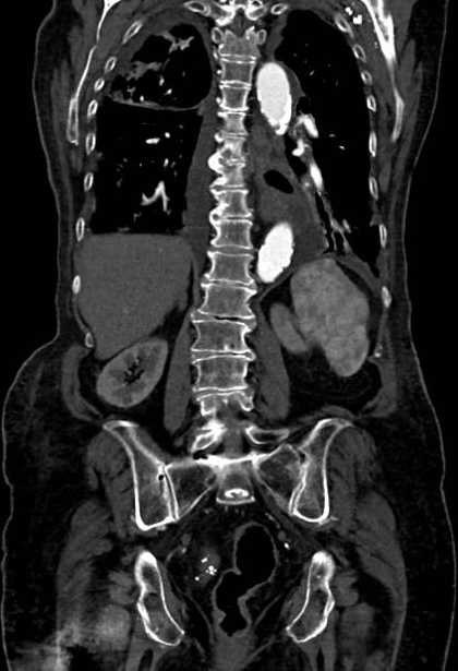 Abdominal aortic aneurysm with thrombus fissuration (Radiopaedia 73192-83919 Coronal C+ arterial phase 62).jpg