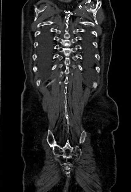 Abdominal aortic aneurysm with thrombus fissuration (Radiopaedia 73192-83919 Coronal C+ arterial phase 84).jpg