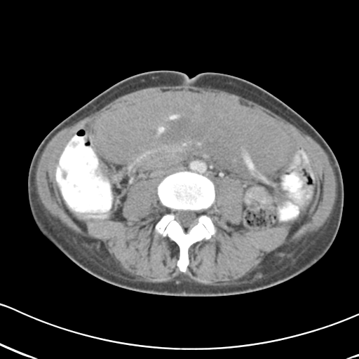 Abdominal desmoid tumor (Radiopaedia 41007-43740 Axial C+ portal venous phase 39).png