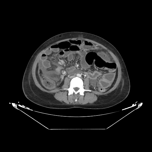 Abdominal gossypiboma- surgical towel (Radiopaedia 57288-64226 Axial C+ portal venous phase 39).jpg