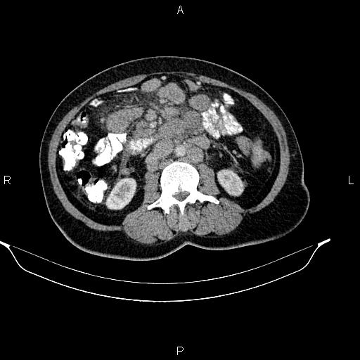 Abdominal lymphoma with sandwich sign (Radiopaedia 84378-99704 Axial C+ portal venous phase 30).jpg
