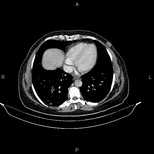 Abdominal lymphoma with sandwich sign (Radiopaedia 84378-99704 Axial C+ portal venous phase 5).jpg