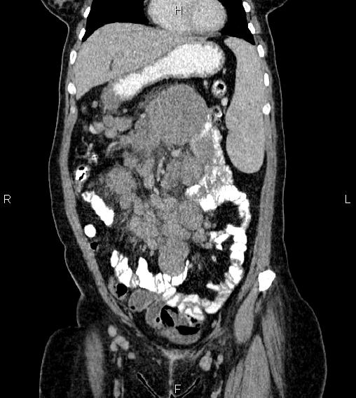 Abdominal lymphoma with sandwich sign (Radiopaedia 84378-99704 Coronal C+ portal venous phase 14).jpg