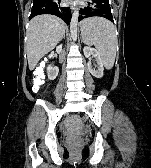 Abdominal lymphoma with sandwich sign (Radiopaedia 84378-99704 Coronal C+ portal venous phase 43).jpg
