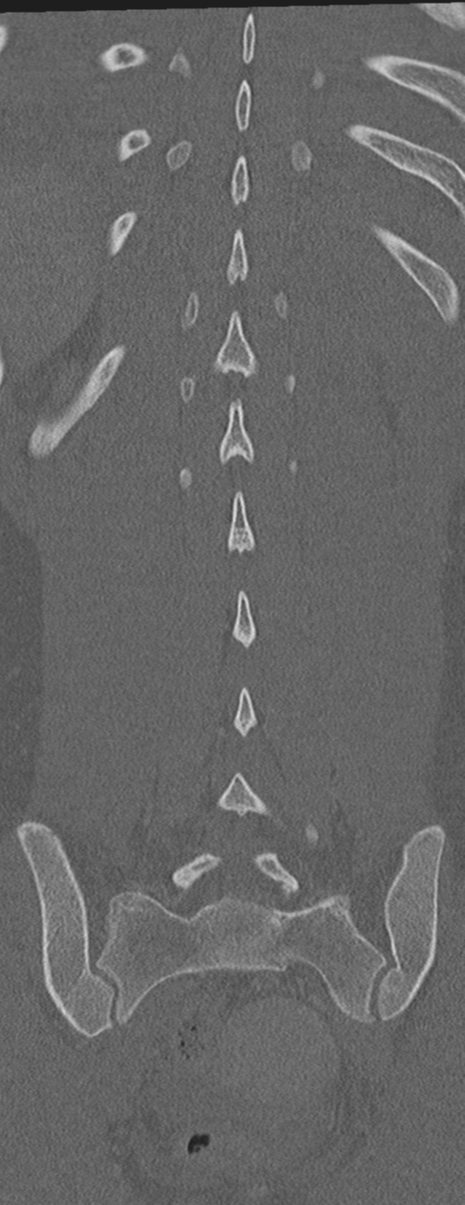 Abdominal multi-trauma - devascularised kidney and liver, spleen and pancreatic lacerations (Radiopaedia 34984-36486 Coronal bone window 54).png