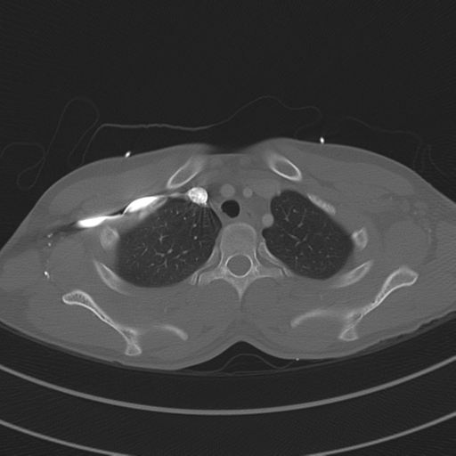 Abdominal multi-trauma - devascularised kidney and liver, spleen and pancreatic lacerations (Radiopaedia 34984-36486 I 18).png