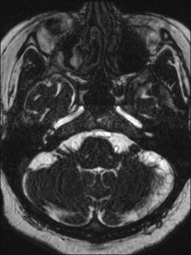 Abducens nerve palsy (Radiopaedia 57084-63976 Axial T2 ciss 3d 19).jpg