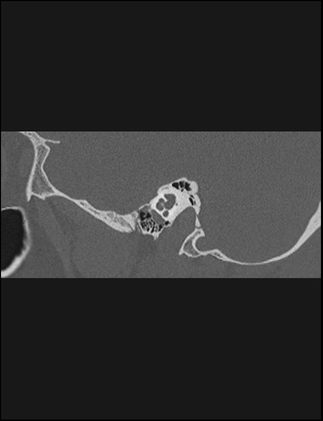 Aberrant right internal carotid artery (Radiopaedia 65191-74198 Sagittal non-contrast 56).jpg