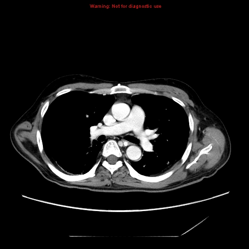 File:Aberrant right subclavian artery (Radiopaedia 9379-10071 Axial C+ arterial phase 29).jpg