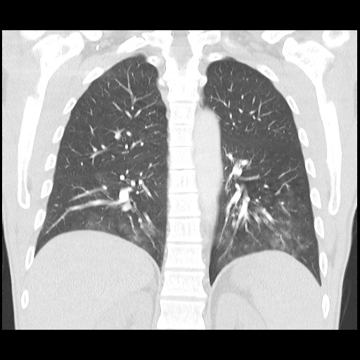 Accessory left horizontal fissure with lingular pneumonia (Radiopaedia 53763-59843 Coronal lung window 31).jpg