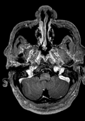 Accessory middle cerebral artery (Radiopaedia 73114-83828 Axial T1 C+ 160).jpg
