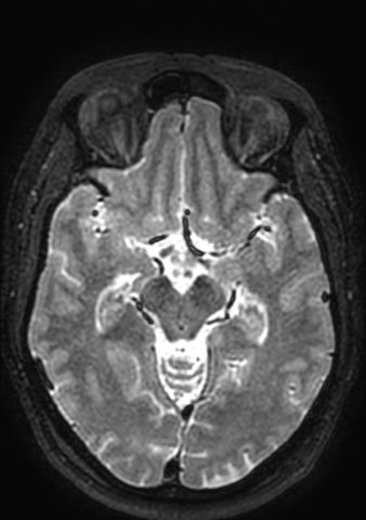 Accessory middle cerebral artery (Radiopaedia 73114-83828 Axial T2 105).jpg