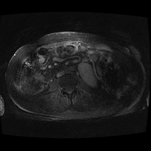 Acinar cell carcinoma of the pancreas (Radiopaedia 75442-86668 Axial late phase (~30 mins) 3).jpg